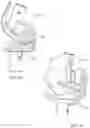 Fig. 09 - ANATOMICAL MOTION HINGED PROSTHESIS