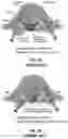 Fig. 03 - Methods and Implants for Facet Joint Stabilization or Fusion