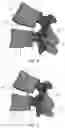 Fig. 04 - Pedicle-based intradiscal fixation devices and methods