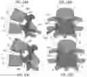 Fig. 12 - Pedicle-based intradiscal fixation devices and methods