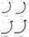 Fig. 19 - Pedicle-based intradiscal fixation devices and methods