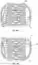 Fig. 89 - Expandable inter-body device, system and method