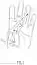 Fig. 02 - Tool for reaming a carpal bone