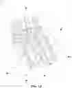 Fig. 13 - Low-cost prosthetic apparatus, methods, kits, and systems with improved force transfer elements