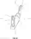 Fig. 24 - Low-cost prosthetic apparatus, methods, kits, and systems with improved force transfer elements