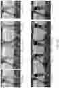 Fig. 09 - Foot orthosis