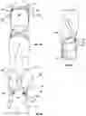 Fig. 34 - ORTHOPEDIC DEVICE FOR TREATING COMPLICATIONS OF THE HIP