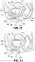 Fig. 11 - Intravaginal device