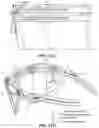 Fig. 17 - Stackable eye shields with selectively releasable snap-fit assembly