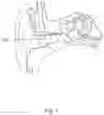 Fig. 02 - CERUMEN REMOVAL APPARATUS