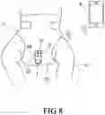 Fig. 09 - Diaper adapted to mount a wetness notifying device