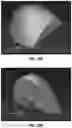 Fig. 11 - METHODS AND COMPOSITIONS FOR ALTERING TEETH
