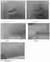 Fig. 02 - Compositions and methods for treating and removing seborrheic keratoses