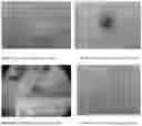 Fig. 04 - Compositions and methods for treating and removing seborrheic keratoses