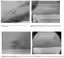 Fig. 05 - Compositions and methods for treating and removing seborrheic keratoses