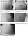 Fig. 06 - Compositions and methods for treating and removing seborrheic keratoses