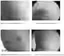 Fig. 07 - Compositions and methods for treating and removing seborrheic keratoses