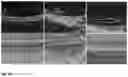 Fig. 16 - Method for the Treatment of a Disease Using Pigment Epithelium-Derived Factor (PEDF)
