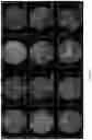 Fig. 18 - HIGHLY EFFICIENT TRANSDUCTION AND LATERAL SPREAD IN THE RETINA BY A NOVEL AAV VIRUS ENHANCED BY RATIONAL DESIGN