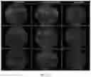 Fig. 20 - HIGHLY EFFICIENT TRANSDUCTION AND LATERAL SPREAD IN THE RETINA BY A NOVEL AAV VIRUS ENHANCED BY RATIONAL DESIGN