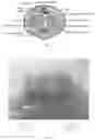 Fig. 02 - PENIS AUGMENTATION