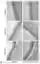 Fig. 08 - Methods and polymer compositions for treating retinal detachment and other ocular disorders