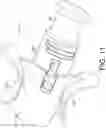 Fig. 17 - Injection delivery device