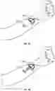 Fig. 06 - IV CATHETER INSERTION GUIDE