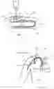 Fig. 02 - SUBCUTANEOUSLY CHANGEABLE VASCULAR ACCESS PORT