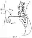 Fig. 02 - Implantable access port with one-directional filter