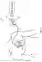 Fig. 02 - Tools for pacemaker lead implantation