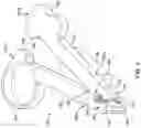 Fig. 04 - Tools for pacemaker lead implantation