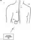 Fig. 01 - Implantable lead location using ECAP