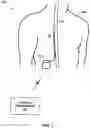 Fig. 02 - Implantable lead location using ECAP