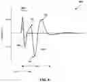Fig. 05 - Implantable lead location using ECAP