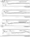 Fig. 10 - Artifact reduction in a sensed neural response