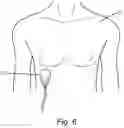 Fig. 07 - SINGLE-USE PATCH