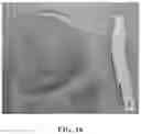 Fig. 17 - Methods for manufacturing and distributing semi-rigid acoustic coupling articles and packaging for ultrasound imaging