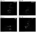 Fig. 21 - Methods of using PDX1-positive pancreatic endoderm cells and endocrine precursor cells