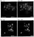 Fig. 33 - Methods of using PDX1-positive pancreatic endoderm cells and endocrine precursor cells