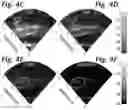 Fig. 11 - Real-time photoacoustic imaging using a precise forward model and fast iterative inverse