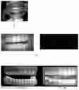 Fig. 04 - Method for analyzing a photo of a dental arch
