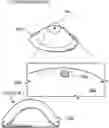Fig. 01 - Restriction of suspension dimple contact point