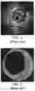 Fig. 03 - Device and Method for Determining the Likelihood of a Patient Having a Clinical Event or a Clinically Silent Event Based on Ascertained Physiological Parameters