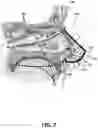 Fig. 08 - NASAL MASK METHOD AND DEVICES