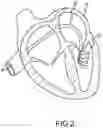 Fig. 03 - HIGH DENSITY ELECTRODE CATHETERS