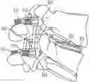 Fig. 01 - Systems and methods for Percutaneous Spinal Interbody Fusion (PSIF)