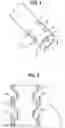 Fig. 04 - Medical device for stone management