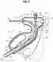 Fig. 05 - Medical device for stone management