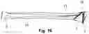 Fig. 08 - DISTAL RADIUS FRACTURE FIXATION DEVICE